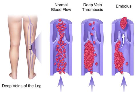 clotsity|Signs of Blood Clot in Leg: Visible and Invisible Clues .